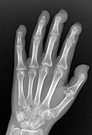 "Vanishing Fingers" Acro-osteolysis in a patient with Scleroderma and renal failure and bilateral hand pain. Causes of AO include Scleroderma, PsA, hypertrophic osteoarthropathy, skeletal dysplasias, frostbite, Hyperparathyroidism, genetic disorders buff.ly/3MuuzLV