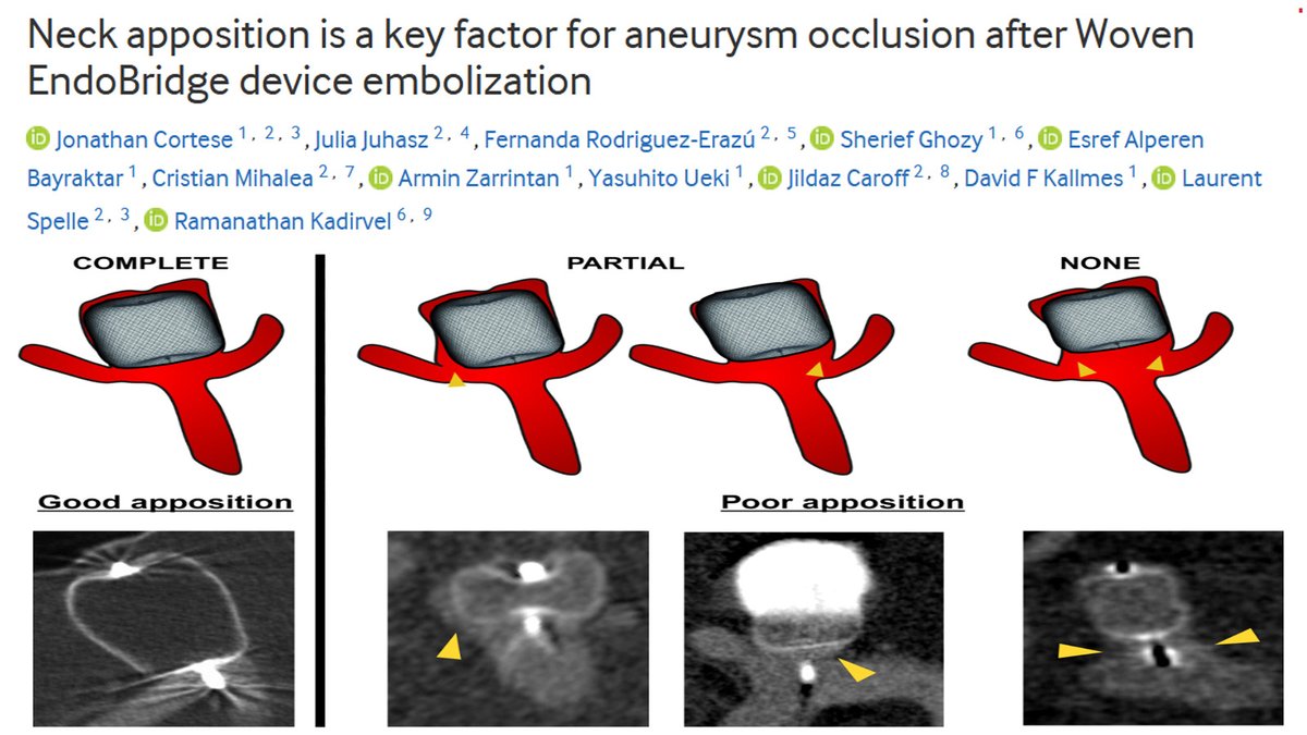 Sherief Ghozy, MD (@sheriefghozy) on Twitter photo 📊 Our latest study reveals that good neck apposition with the WEB device significantly enhances aneurysm occlusion rates—82% adequate and 65% complete occlusion. Key insights to consider in treatment planning.
Read more: bit.ly/4dPtr1r
<a href="/drjon_neuri/">Jonathan Cortese</a> <a href="/ealperen97/">Eşref Alperen Bayraktar, MD</a> 📊 Our latest study reveals that good neck apposition with the WEB device significantly enhances aneurysm occlusion rates—82% adequate and 65% complete occlusion. Key insights to consider in treatment planning.
Read more: bit.ly/4dPtr1r
<a href="/drjon_neuri/">Jonathan Cortese</a> <a href="/ealperen97/">Eşref Alperen Bayraktar, MD</a>
