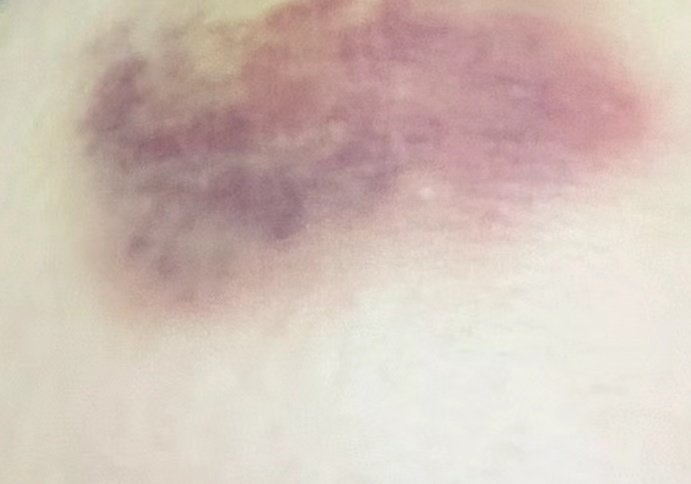 f711258's tweet photo. 事情经过
现在身上都是这种青紫色
就不给担心的大家一一发了
没关系我现在很好
等我好了再给粉丝发图 https://t.co/4AyBwRpPS3