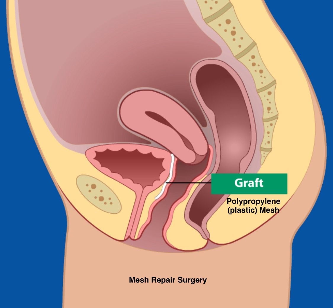 Do you still quote the 30% failure rate of prolapse surgery to your patients? 
Time to think again 🤔 ...

The pivotal 1997 Olsen study reported a concerning 29.2% re-operation rate following natural tissue surgery for prolapse in women. 
The study, however, is often