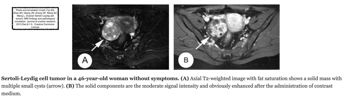 Path4People's tweet image. 📚Sertoli-Leydig Cell Tumor (Ovary)

📕 Sex Cord Stromal Tumor 
2️⃣ Cells: Sertoli + Leydig cells
📈 ~97% Unilateral
📊 Average age+size: 25 y/o+13cm
📈 40-60% w androgenic symptoms
🧬 Ass DICER1 syndrome
➗Well;mod;poorly diff based on tubular diff of Sertoli cell
🎨SF1+

#gynonc