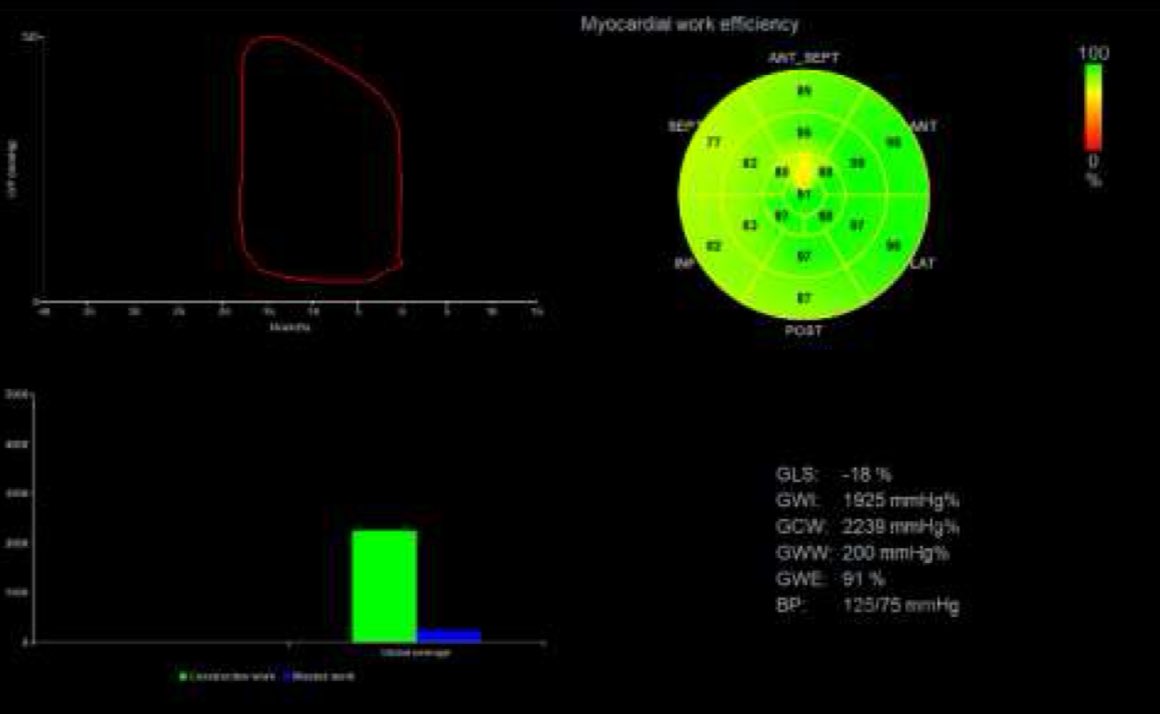 EHJ-IMP Editor-in-Chief (@ehjimpeic) on Twitter photo Goodmorning #EHJIMP āļøThis study by <a href="/DrGEMandoli/">Giulia Elena Mandoli, MD, PhD, FESC, FISC</a> provides reference ranges for #myocardialwork indices in an adult HTx population free from transplant-related complications which proved to be different from those previously reported in healthy volunteers academic.oup.com/ehjimp/advance⦠Goodmorning #EHJIMP āļøThis study by <a href="/DrGEMandoli/">Giulia Elena Mandoli, MD, PhD, FESC, FISC</a> provides reference ranges for #myocardialwork indices in an adult HTx population free from transplant-related complications which proved to be different from those previously reported in healthy volunteers academic.oup.com/ehjimp/advanceā¦