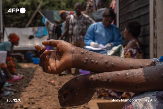 File photo shows a patient suffering from mpox at the Kavumu hospital, 30 km north of Bukavu in eastern Democratic Republic of Congo, on August 24, 2024