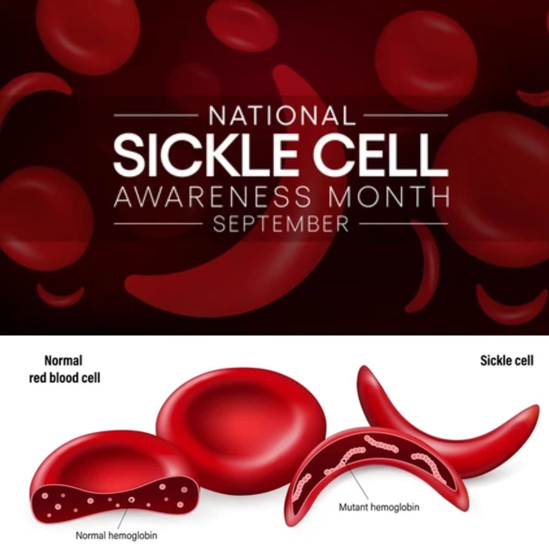 🩸 September is #SickleCellAwarenessMonth! Sickle Cell Disease affects millions across Africa, causing painful crises &amp; serious health issues. Early diagnosis &amp; better healthcare access are vital. Let’s raise awareness and support those impacted on our continent. 💪🏿 #SickleCell