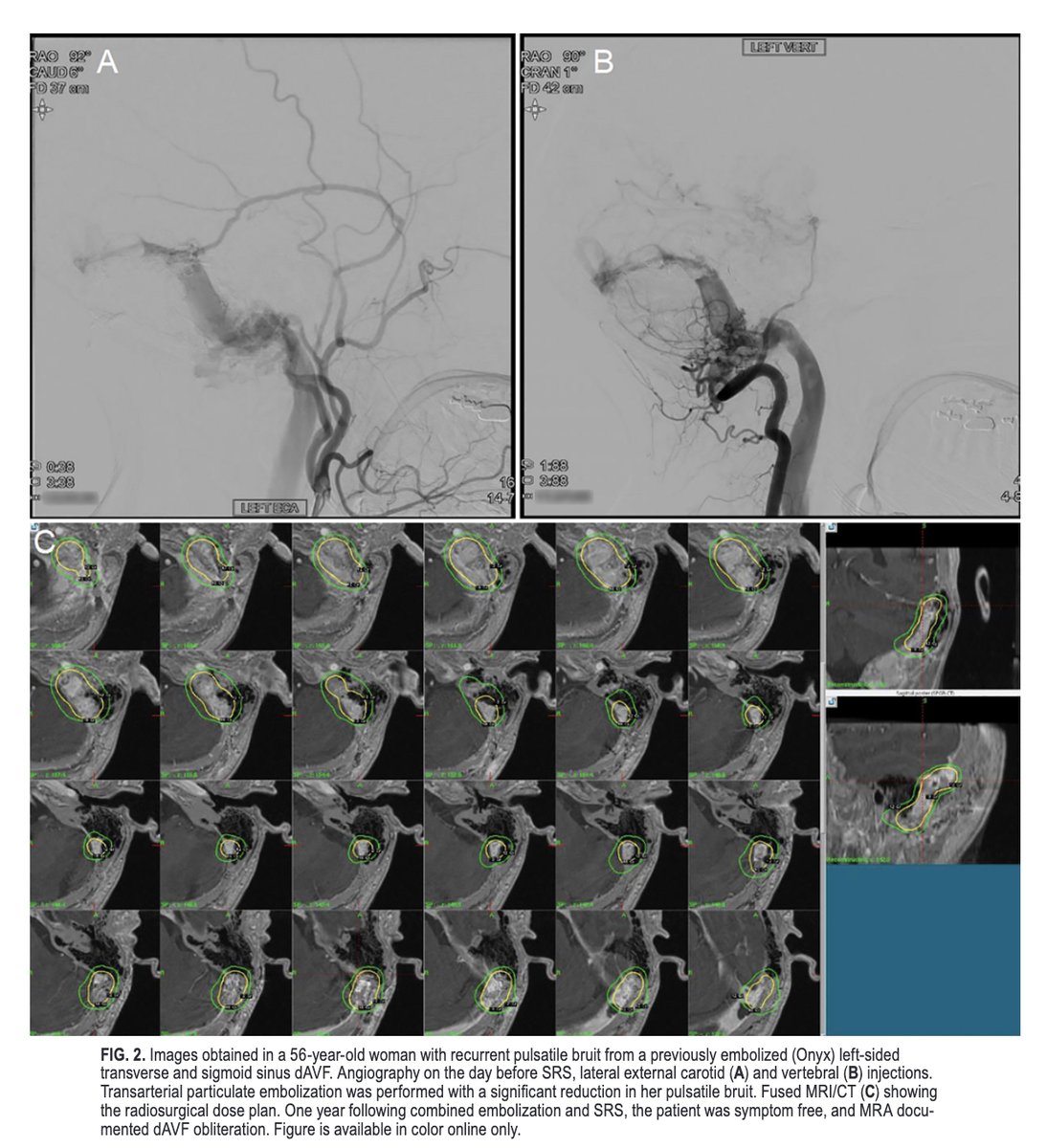 #OnlineFirst: Stereotactic radiosurgery for intracranial dural arteriovenous fistulas: patient outcomes and lessons learned over a 3-decade single-center experience. 

thejns.org/view/journals/….