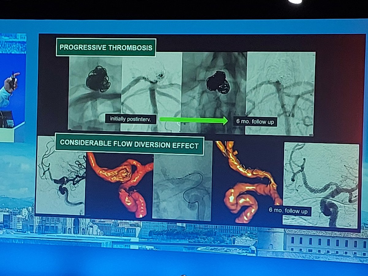 ehsan_m_h76's tweet image. کنگره ESMINT 2024, فرانسه، مارسی.
#ESMINT #Marseille #Neurointervention #Neurovascular