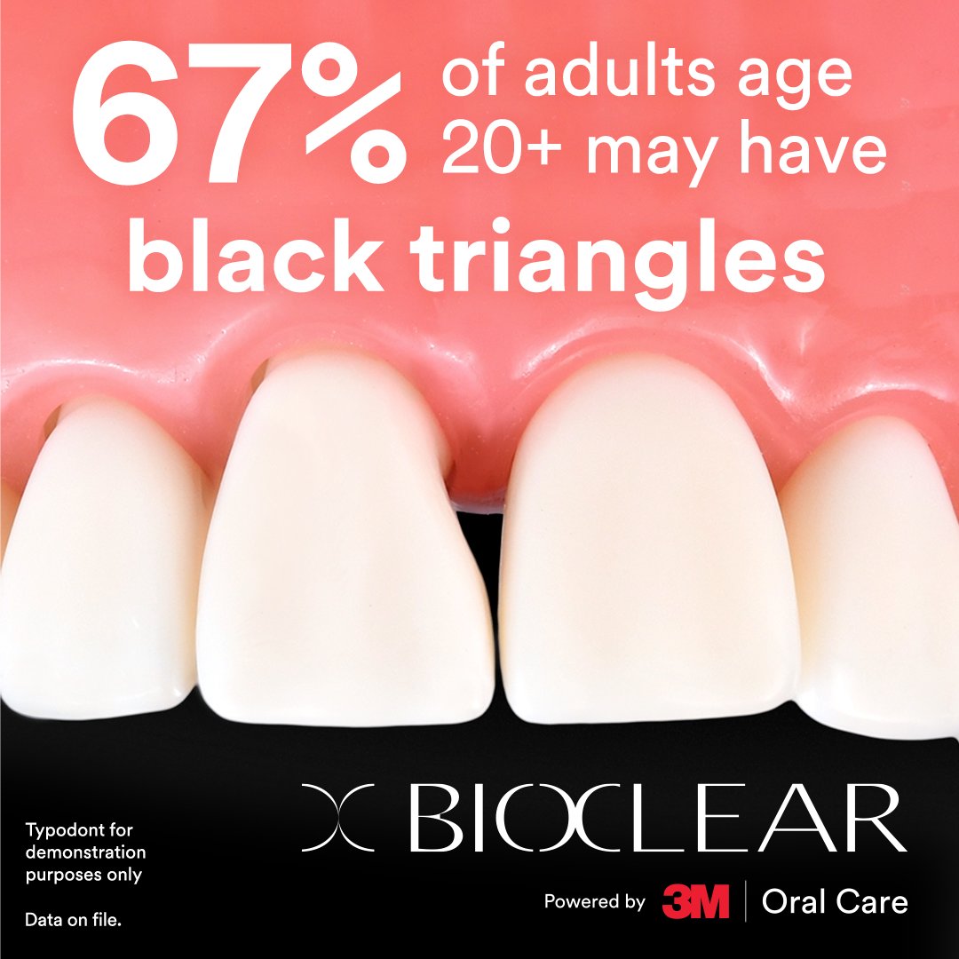 rajagopalbs's tweet photo. Black triangles don’t have to loom large. Learn the Bioclear™ Method and transform patients’ smiles – without veneers. Learn more: https://t.co/EF8b7KLfRF https://t.co/jV6W5oEkVK