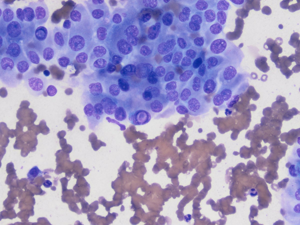 UABPathology's tweet photo. This week's #UABCyto case from Dr. Igor Damasceno: 37 y/o F with a thyroid nodule. Hypercellular smear with cells in flat sheets and papillary structures. Nuclei with grooves, overlapping and pseudoinclusions. Dx: Papillary Thyroid Carcinoma. https://t.co/zkwSTcNNf6