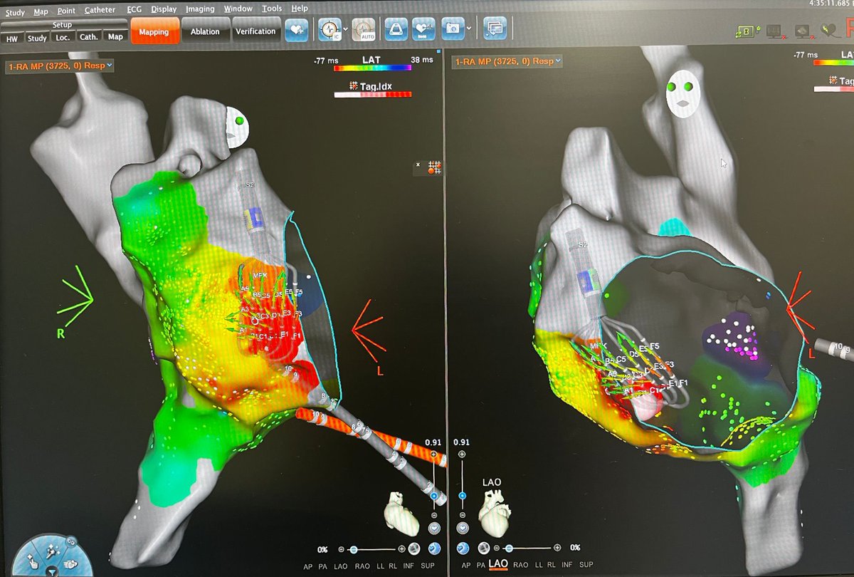 First time working with the Biosense Optrell catheter for me. Quite an interesting experience. 

It worked really well for this right atrial tachycardia from the annulus 

<a href="/MaastrichtUMC/">Maastricht UMC+</a> <a href="/Dominik_Linz/">Dominik Linz</a> <a href="/JLuermans/">Justin Luermans</a> <a href="/UliSchotten/">Uli Schotten</a> <a href="/HermansBJM/">Ben JM Hermans, PhD</a> <a href="/harry_crijns/">harry crijns</a> <a href="/CARIMMaastricht/">CARIM</a>
