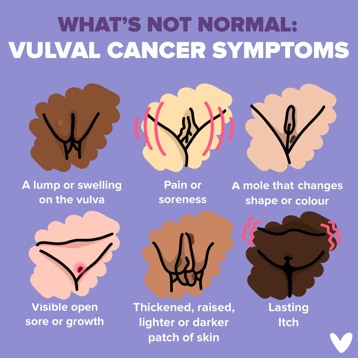 Everyone’s vulva is unique– the shape, size, texture and scent, which is why it’s important to know what’s normal for you. This way, any changes—no matter how small—are easier to spot, potentially catching cancer early when it’s more treatable. 

So what is normal &amp; what's not?