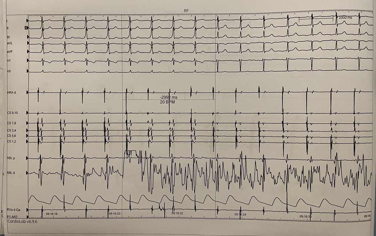 Alberto Barengo (@albertobareng) on Twitter photo Probably love in EP starts with accessory pathways. Very small discrete structures producing big changes in the ECG. One shot ablation can be curative.
Today ablation of a left AP in a 12 yrs old girl, by Dr. Gulletta in <a href="/SRArrhythmology/">San Raffaele Arrhythmology</a> Probably love in EP starts with accessory pathways. Very small discrete structures producing big changes in the ECG. One shot ablation can be curative.
Today ablation of a left AP in a 12 yrs old girl, by Dr. Gulletta in <a href="/SRArrhythmology/">San Raffaele Arrhythmology</a>