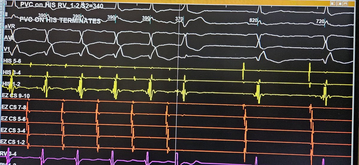 PJRT .....fast slow type tachycardia always PVC on HIS ....and then you diagnose PJRT ....