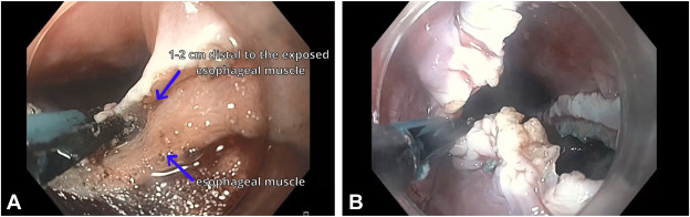 iGIE (@igiejournal) on Twitter photo In iNNOVATIONS: iMAGES, Fayyaz et al engage in "Unveiling the unsealed: modified Zenkerās peroral endoscopic myotomy with open incision." igiejournal.org/article/S2949-ā¦
<a href="/MouenKhashab/">Mouen Khashab, MD, MASGE</a>
<a href="/MetabolicEndo/">Chris Thompson, MD</a> <a href="/gutdoc18/">Janese Laster, MD</a> In iNNOVATIONS: iMAGES, Fayyaz et al engage in "Unveiling the unsealed: modified Zenkerās peroral endoscopic myotomy with open incision." igiejournal.org/article/S2949-ā¦
<a href="/MouenKhashab/">Mouen Khashab, MD, MASGE</a>
<a href="/MetabolicEndo/">Chris Thompson, MD</a> <a href="/gutdoc18/">Janese Laster, MD</a>