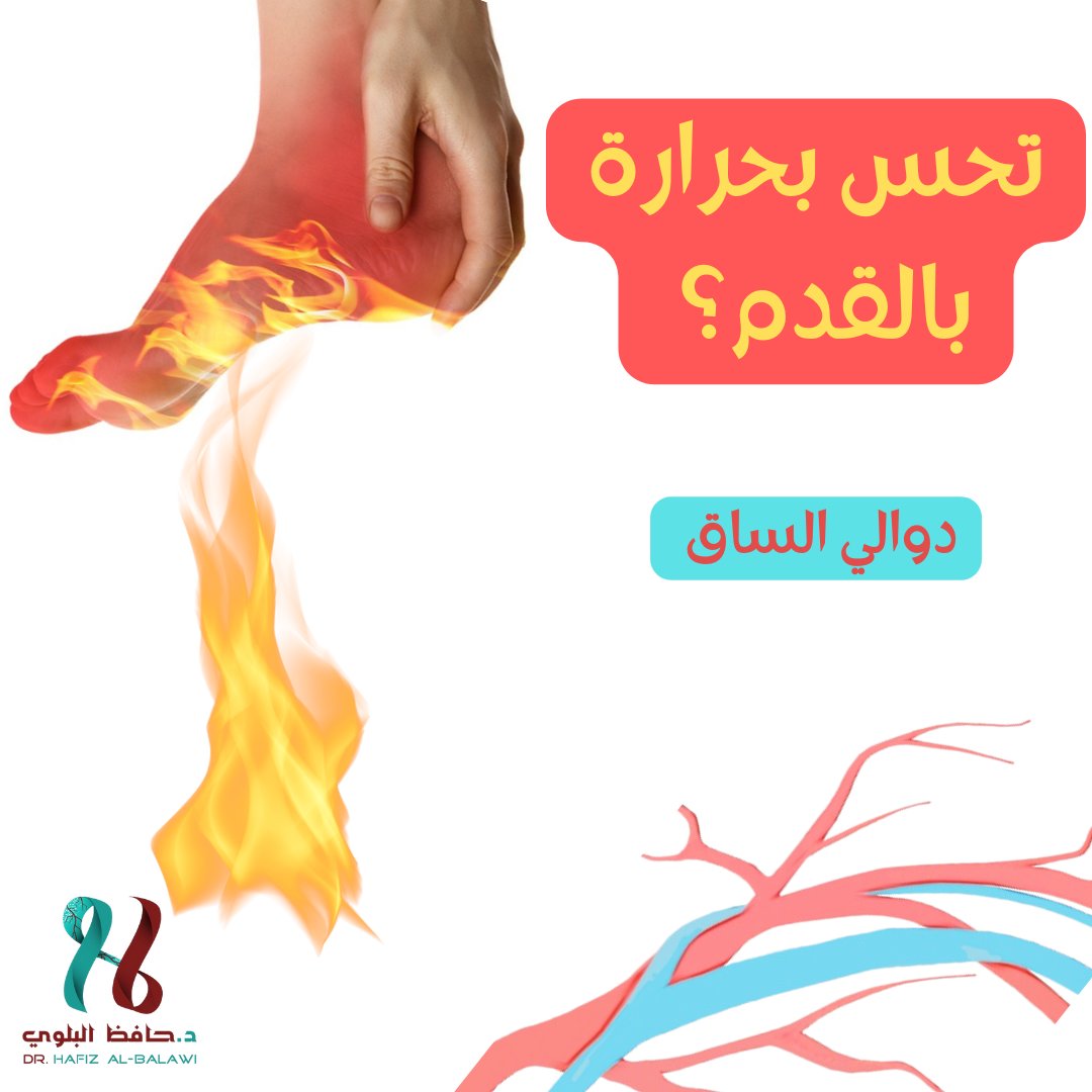 DrAlbalwi's tweet photo. @videonet_ بالاضافة لما ذُكر، احد اهم مسببات الاحساس بالحرارة بالقدمين هو الإصابة ب #دوالي_الساق https://t.co/E4A0OklkKX