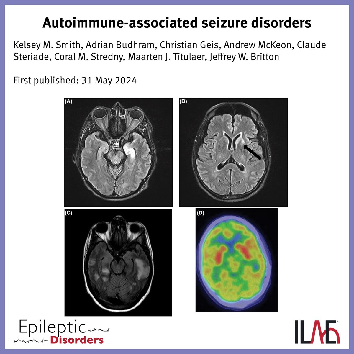 International League Against Epilepsy (@ilaeweb) on Twitter photo Key point: "Antibodies to LGI1, NMDAR, and GAD65 are the most common antibodies found in patients with autoimmune encephalitis and autoimmune-associated seizure disorders."
<a href="/EpiDisorders/">Epileptic Disorders</a> doi.org/10.1002/epd2.2… Key point: "Antibodies to LGI1, NMDAR, and GAD65 are the most common antibodies found in patients with autoimmune encephalitis and autoimmune-associated seizure disorders."
<a href="/EpiDisorders/">Epileptic Disorders</a> doi.org/10.1002/epd2.2…