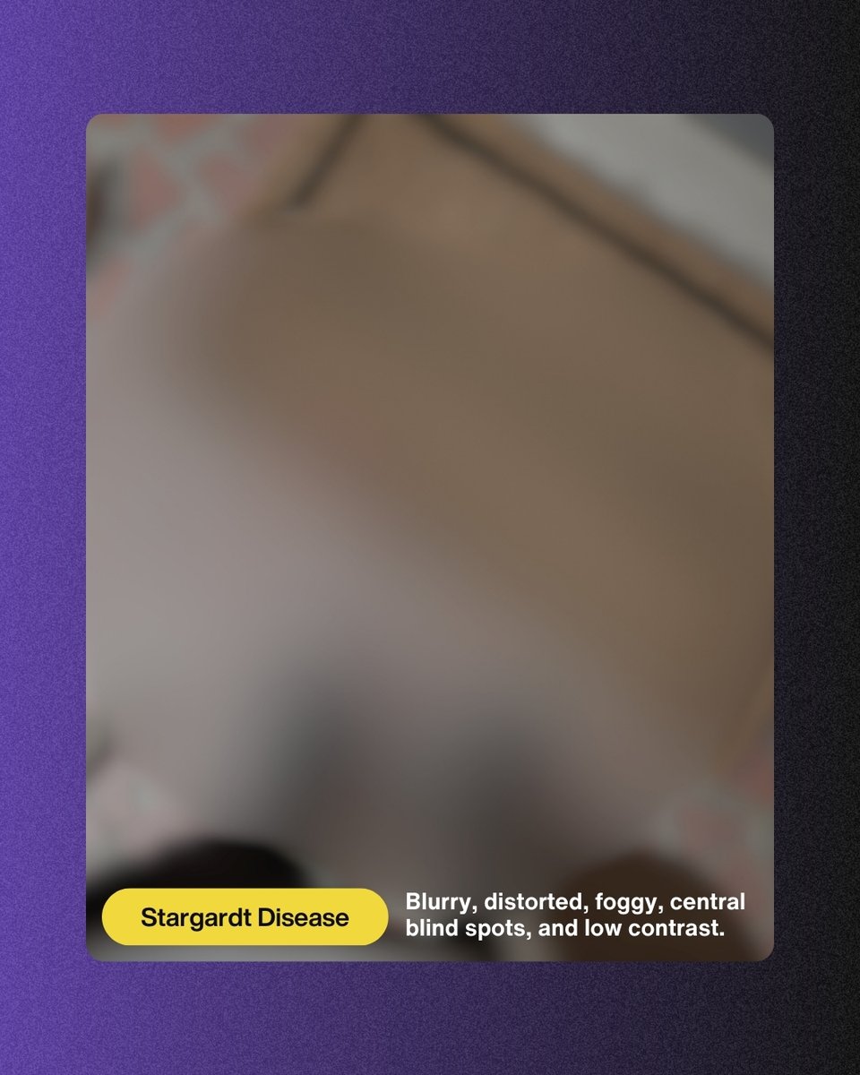 This is what Stargardt Disease looks like.