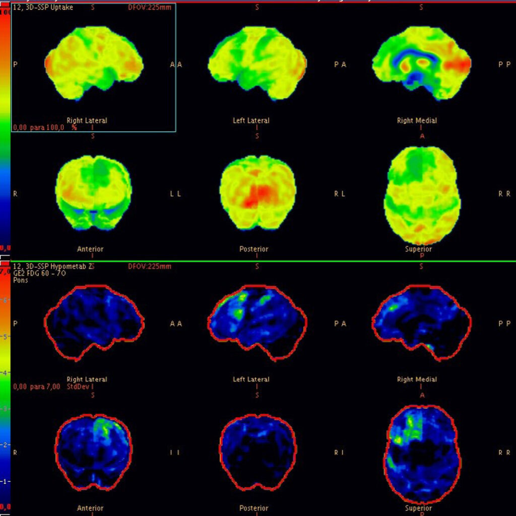 Phenotypic and Positron Emission Tomography with [18F]fluordeoxyglucose (FDG PET) differences in corticobasal syndrome: comparison of two cases. 
fou8.short.gy/5XDp4S