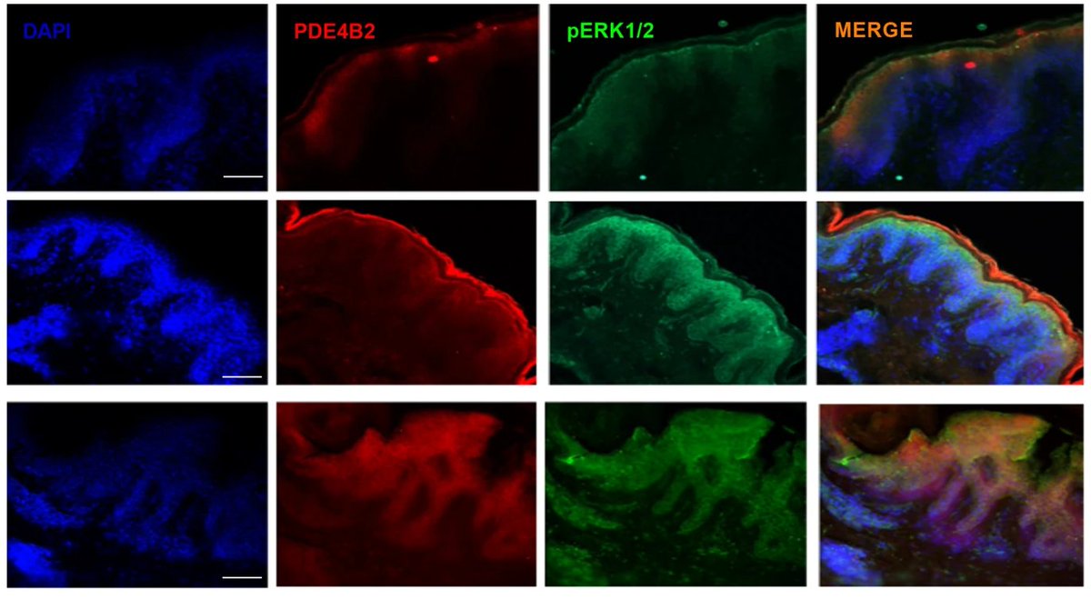 Dermal Cell News (@dermalcell) on Twitter photo In this <a href="/MolMedBMC/">Molecular Medicine - Journal</a> study, scientists analyzed the expression of PDE4 isoforms on the epidermis of hypertrophic scars and keloids, and the role of PDE4 on the #keratinocyte activation.
🔗 bit.ly/47bXUV5 In this <a href="/MolMedBMC/">Molecular Medicine - Journal</a> study, scientists analyzed the expression of PDE4 isoforms on the epidermis of hypertrophic scars and keloids, and the role of PDE4 on the #keratinocyte activation.
🔗 bit.ly/47bXUV5