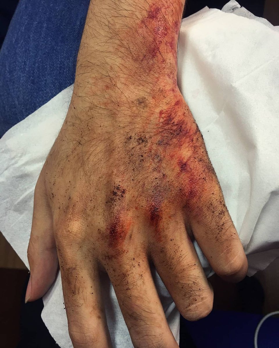 Besok gw tanding pas tangan gw gini