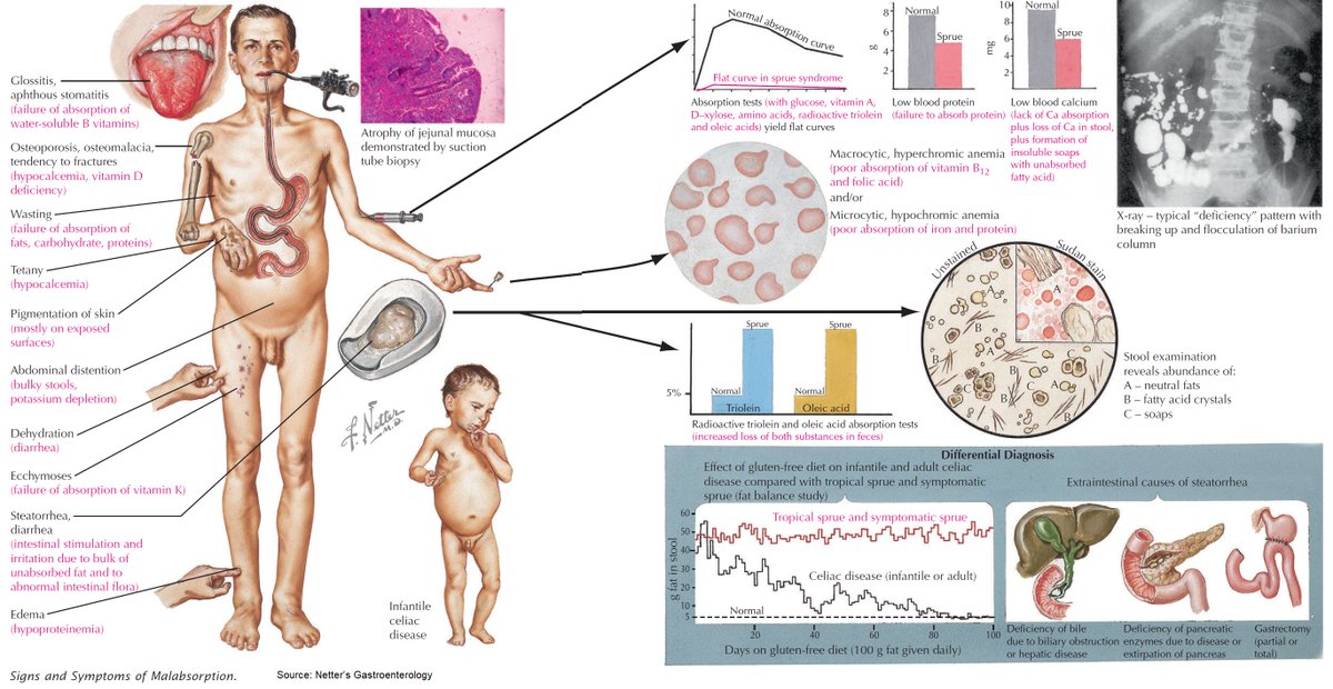 Signs and Symptoms of Malabsorption

#medtwitter #foamed #usmle