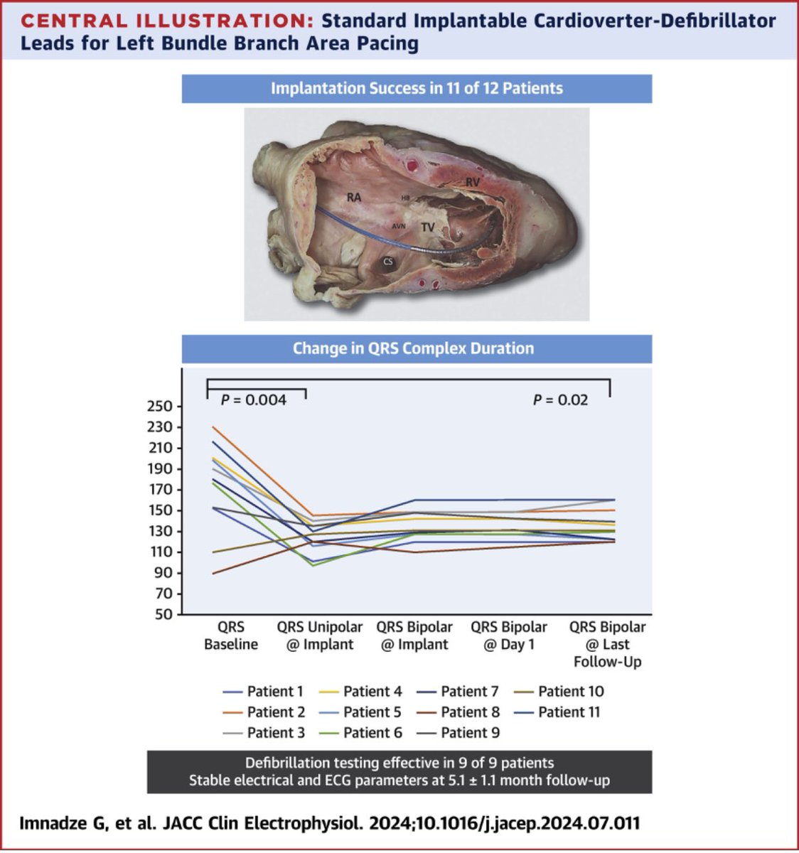 Guram Imnadze (@guramimnadze) on Twitter photo ⚡️Standard Defibrillator Leads for Left Bundle Branch Area Pacing: First... sciencedirect.com/science/articl…
<a href="/HdzNrw/">HDZ NRW</a> <a href="/Phiso_de/">Philipp Sommer</a> <a href="/HaranBurri/">Haran Burri</a> <a href="/Cardioschool/">Maxim Didenko, MD PhD</a> <a href="/AGEP_DGK/">AGEP</a> <a href="/YoungDgk/">Young DGK</a> <a href="/Hisdoc1/">Pugal Vijayaraman</a> <a href="/Marek_Jastrz_EP/">Marek Jastrzębski</a> <a href="/OCanoPerez/">Óscar Cano</a> <a href="/kvernooy/">Kevin Vernooy</a> <a href="/EHRAPresident/">EHRAPresident</a> <a href="/DGK_org/">Deutsche Gesellschaft für Kardiologie</a> <a href="/DrRoderickTung/">Roderick Tung</a> #LBBAP #epeeps ⚡️Standard Defibrillator Leads for Left Bundle Branch Area Pacing: First... sciencedirect.com/science/articl…
<a href="/HdzNrw/">HDZ NRW</a> <a href="/Phiso_de/">Philipp Sommer</a> <a href="/HaranBurri/">Haran Burri</a> <a href="/Cardioschool/">Maxim Didenko, MD PhD</a> <a href="/AGEP_DGK/">AGEP</a> <a href="/YoungDgk/">Young DGK</a> <a href="/Hisdoc1/">Pugal Vijayaraman</a> <a href="/Marek_Jastrz_EP/">Marek Jastrzębski</a> <a href="/OCanoPerez/">Óscar Cano</a> <a href="/kvernooy/">Kevin Vernooy</a> <a href="/EHRAPresident/">EHRAPresident</a> <a href="/DGK_org/">Deutsche Gesellschaft für Kardiologie</a> <a href="/DrRoderickTung/">Roderick Tung</a> #LBBAP #epeeps