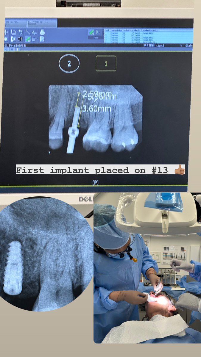 _PrincessKumari's tweet photo. Placed my first implant a couple of weeks ago. Pt came for a 2-week followup and tissue is healing goooood 👏🏽 #Dentistry #DentalResident #Biohorizon #Implants https://t.co/QgZTA6Lr0o