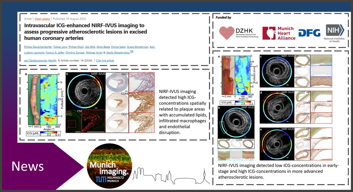 MunichImaging (@munichimaging) on Twitter photo #intravascular ICG-enhanced #NIRF-#IVUS can visualize prognostically relevant pathobiological features of #atherosclerotic #plaques, which can support clinical decision-making by early detection of progressive lesions.
<a href="/Nature_NPJ/">npj Journals</a> Cardiovascular Health
nature.com/articles/s4432… #intravascular ICG-enhanced #NIRF-#IVUS can visualize prognostically relevant pathobiological features of #atherosclerotic #plaques, which can support clinical decision-making by early detection of progressive lesions.
<a href="/Nature_NPJ/">npj Journals</a> Cardiovascular Health
nature.com/articles/s4432…