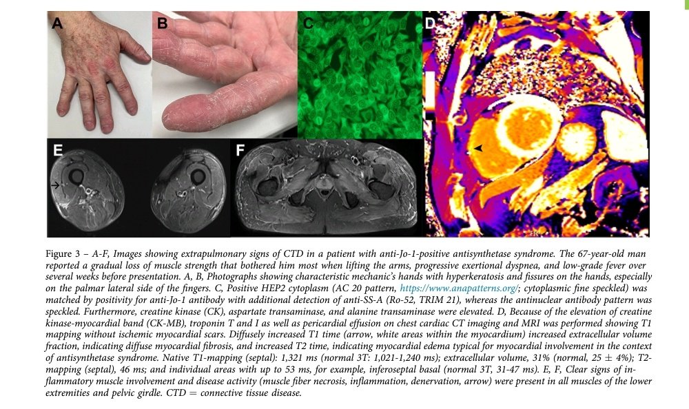 Diagnosis and Management of Patients With Interstitial Lung Disease and Connective Tissue Disease

⏩Interdisciplinary collaboration enhances patient care, speeds up diagnosis, and enriches professional skills

journal.chestnet.org/article/S0012-…