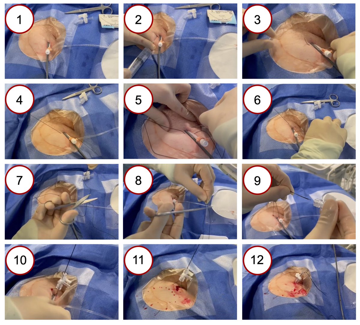A cheap and easy technique that all electrophysiologists should be using after EP procedures 

✅ Figure-of-eight suture with 3-way stopcock 🪢

Read more (open access): onlinelibrary.wiley.com/doi/full/10.11…

#EPeeps #CardioEd