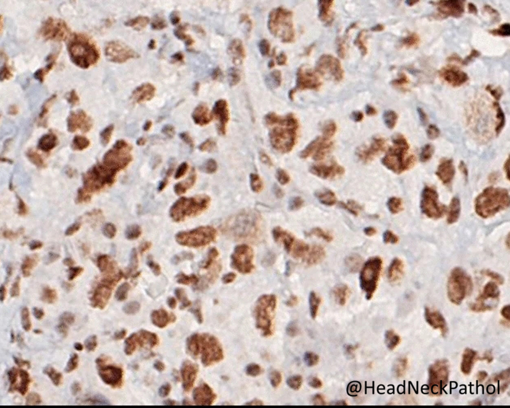 Primary Oropharyngeal SMARCA4-Deficient Carcinoma: Expanding the Diagnostic Spectrum in Head and Neck Cancer
S Pasricha, S Goyal, M Kamboj, H Diwan, M Gairola, et al
rdcu.be/dS6ew
#HeadNeckPathol #HNPJ #HeadandNeckPath #Pathology #ENTPath #PathologyTweet