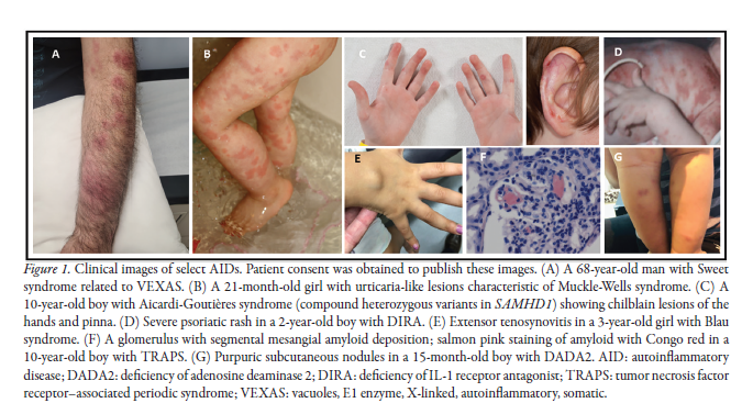 Expert Review

Autoinflammatory Diseases: A Review

📖 doi.org/10.3899/jrheum…

#autoinflammation #autoinflammatorydisease #genetics #recurrentfevers