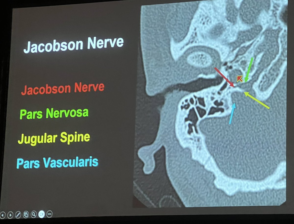 ASHNR (@ashnrsociety) on Twitter photo Beautiful overview of some of the intricate anatomy of the jugular foramen with <a href="/learnneurorad/">Divya Gunda</a> #ASHNR24 Beautiful overview of some of the intricate anatomy of the jugular foramen with <a href="/learnneurorad/">Divya Gunda</a> #ASHNR24