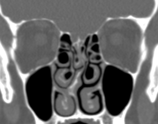 DrScottFortune's tweet photo. Check out this infrequent finding on #SinusCTscan #ConchaBullosa #SuperiorTurbinate #Rhinology #AnantomicVariant https://t.co/GtxnKAEAY1