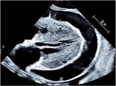 Our case in CRM:IC - patient in cardiac tamponade as the presenting sign of intolerance of a failed, non-functioning transplanted kidney. We describe a treatment escalation and ultimate resolution through transplant nephrectomy. doi.org/10.1016/j.crmi… [kwnsfk27.r.eu-west-1.awstrack.me]