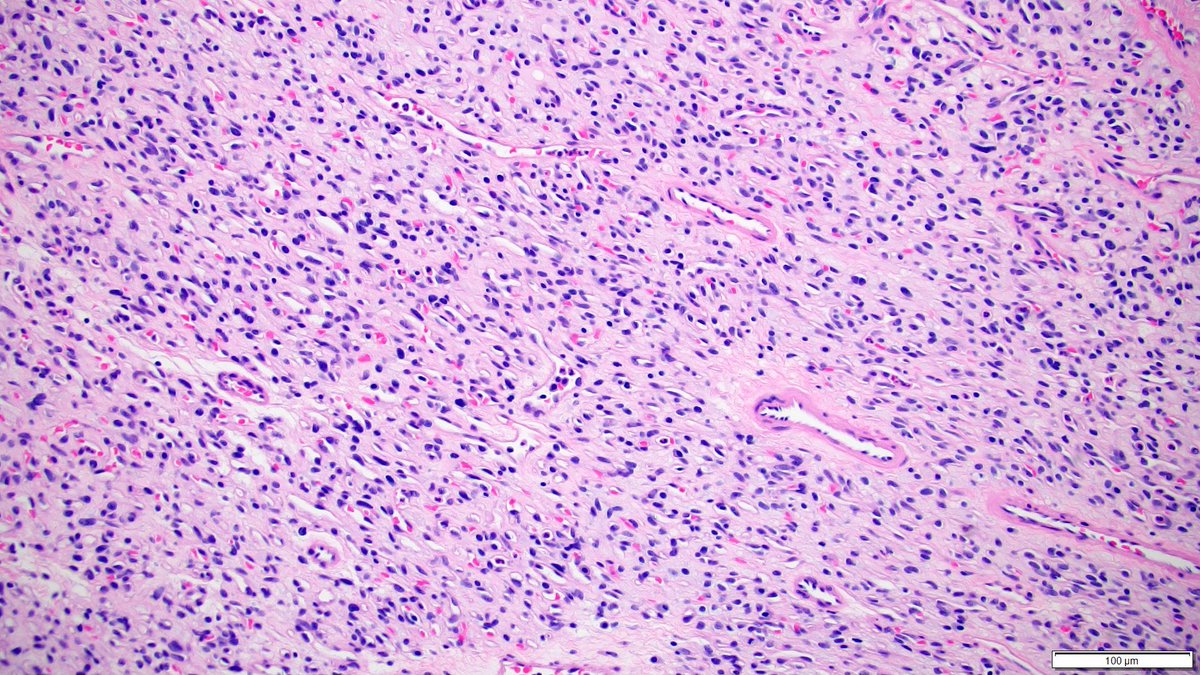 CuringN's tweet photo. Kidney tumor - What's your diagnosis?
Topic link: https://t.co/H6V2fGOr1U
Images contributed by Maria Tretiakova, M.D., Ph.D.
Visit our CCN blog for cancer-related essays by Dr. Pernick: https://t.co/aaLBk9BA8J.
#Cancer #CancerResearch #CuringCancerNetwork #Pathology https://t.co/fh3Fr58Ywh