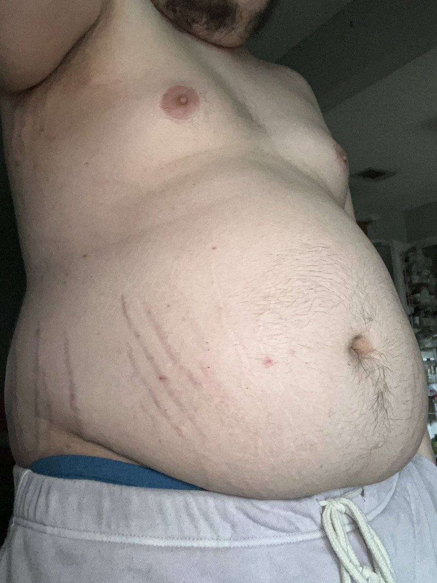 Man look at these stretchmarks 😩
