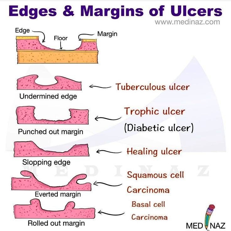 Gazal6849's tweet photo. 🔴Edges &amp; margins of ulcers by Medinaz

#MedicalResearch https://t.co/Dl7BVHoOTl