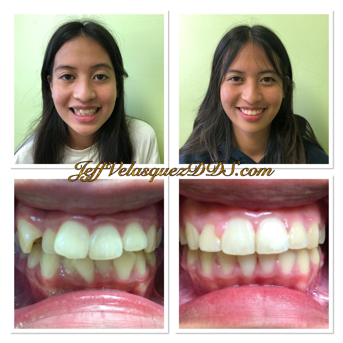 jjvelasquezdds's tweet photo. Another Smile Saved at
562-424-9473
https://t.co/7m8TRKFHv5
Thank you Wave
https://t.co/88fZg2Ct6v https://t.co/C9sZcuBUeM