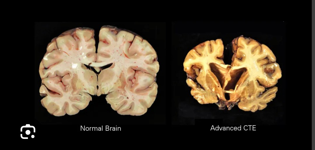 beautifuldaeeee's tweet photo. Just a reminder that 345 out of 376 brains of former nfl players had signs of CTE as of February 2023. Suggesting that around 91% of players have or will develop CTE at some point. It literally puts holes in your brain. #DEFUNDNFL https://t.co/y8MTp269sp