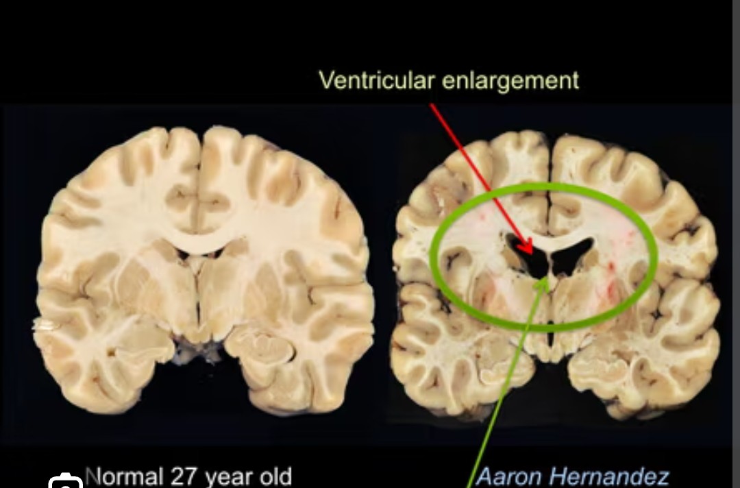 beautifuldaeeee's tweet photo. Just a reminder that 345 out of 376 brains of former nfl players had signs of CTE as of February 2023. Suggesting that around 91% of players have or will develop CTE at some point. It literally puts holes in your brain. #DEFUNDNFL https://t.co/y8MTp269sp