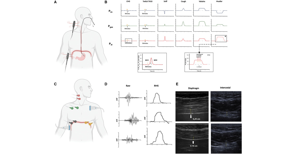 Potential Diaphragm Muscle Weakness-related Dyspnea Persists 2 Years after COVID-19 and Could Be Improved by Inspiratory Muscle Training: Results of an Observational and an Interventional Clinical Trial
<a href="/Transparent_AC/">Jens Spiesshoefer</a> 
<a href="/atscommunity/">American Thoracic Society (ATS)</a> 

🔓 Open Access

🔗 tinyurl.com/4aupp599