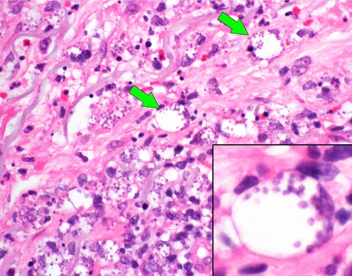Skin ulcer biopsy. Your diagnosis? Answer &amp; video here: kikoxp.com/posts/5733. Pic from my #dermpath survival guide book by <a href="/science_press/">Innovative Science Press</a>: bit.ly/2Te2haB. #pathology #pathologists #pathTwitter  #dermatology #dermatologia #dermtwitter #IDpath #microbiology