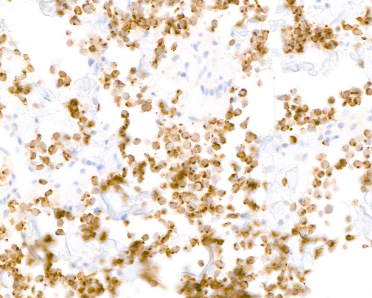 This . . . CK20 . . . immunostaining . . . pattern . . . helped . . . establish . . . the . . . diagnosis . . . of . . . Merkel . . . cell . . . carcinoma . . . status . . . post . . . hepatic . . . transplantation . . . . . . It happens. Not often.