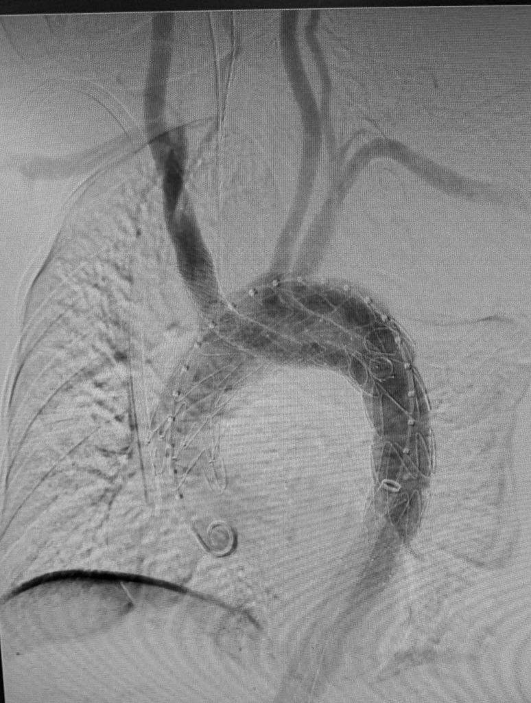 woostermd (@woostermd) on Twitter photo Excited to announce on behalf of <a href="/MUSCVascular/">MUSC Vascular Surgery</a> <a href="/AdamTanious/">Adam Tanious</a> <a href="/DrZeigler1/">Aorta guy</a> and myself, our design for modular, transfemoral, off the shelf aortic arch repair is official US PATENT APPROVED! Hopeful to present our early series at a conference later this year #collaboration #aortaed Excited to announce on behalf of <a href="/MUSCVascular/">MUSC Vascular Surgery</a> <a href="/AdamTanious/">Adam Tanious</a> <a href="/DrZeigler1/">Aorta guy</a> and myself, our design for modular, transfemoral, off the shelf aortic arch repair is official US PATENT APPROVED! Hopeful to present our early series at a conference later this year #collaboration #aortaed