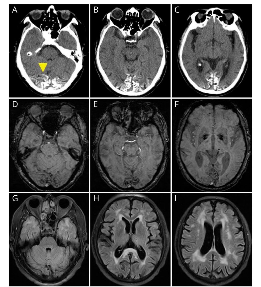 Michael Okun (@michaelokun) on Twitter photo Have you ever seen a case of autosomal dominant Alzheimer’s w/ ribbon like cortical calcifications? Wang and colleagues show us a case in <a href="/GreenJournal/">Neurology Journal</a>.
Key Points:
- The person had ‘recurrent headaches for 20 years, walking instability for 8 years, and memory loss and Have you ever seen a case of autosomal dominant Alzheimer’s w/ ribbon like cortical calcifications? Wang and colleagues show us a case in <a href="/GreenJournal/">Neurology Journal</a>.
Key Points:
- The person had ‘recurrent headaches for 20 years, walking instability for 8 years, and memory loss and