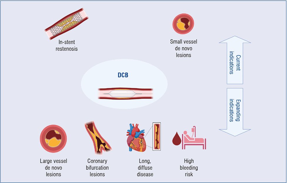 Grupa American Heart of Poland (@ahp_paks) on Twitter photo An article: "Are we at dawn of the drug-coated balloons era? Current evidence, future directions, and tasks of the newly established working group of the Association of Cardiovascular Interventions" published by <a href="/ViaMedica_pl/">Via Medica</a>. Co-authors: <a href="/iwanczyk_sylwia/">Sylwia Iwańczyk</a>, <a href="/KamilBujak12/">Kamil Bujak</a>, Rafał An article: "Are we at dawn of the drug-coated balloons era? Current evidence, future directions, and tasks of the newly established working group of the Association of Cardiovascular Interventions" published by <a href="/ViaMedica_pl/">Via Medica</a>. Co-authors: <a href="/iwanczyk_sylwia/">Sylwia Iwańczyk</a>, <a href="/KamilBujak12/">Kamil Bujak</a>, Rafał