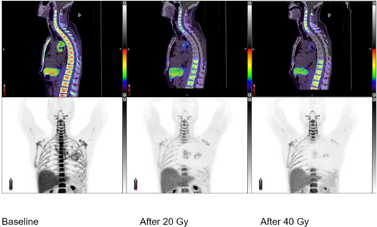 ASTRO (@astro_org) on Twitter photo In this new article from <a href="/MP_MacManus/">Michael MacManus</a>, Dose-response relationships between radiation exposure, bone marrow function as measured by 18F-FLT PET, and lymphocyte counts during chemoradiation for non-small cell lung cancer. Read here in the #RedJournal: tinyurl.com/mcmanusred In this new article from <a href="/MP_MacManus/">Michael MacManus</a>, Dose-response relationships between radiation exposure, bone marrow function as measured by 18F-FLT PET, and lymphocyte counts during chemoradiation for non-small cell lung cancer. Read here in the #RedJournal: tinyurl.com/mcmanusred