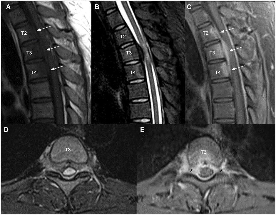BJR_Radiology's tweet image. What's your diagnosis?
A 27-year-old male with insidious onset of bilateral lower limb weakness and numbness over 3 weeks was assessed by orthopaedic surgeons.
Read the #OpenAccess case published in BJR|Case Reports: bit.ly/3TfM2vm