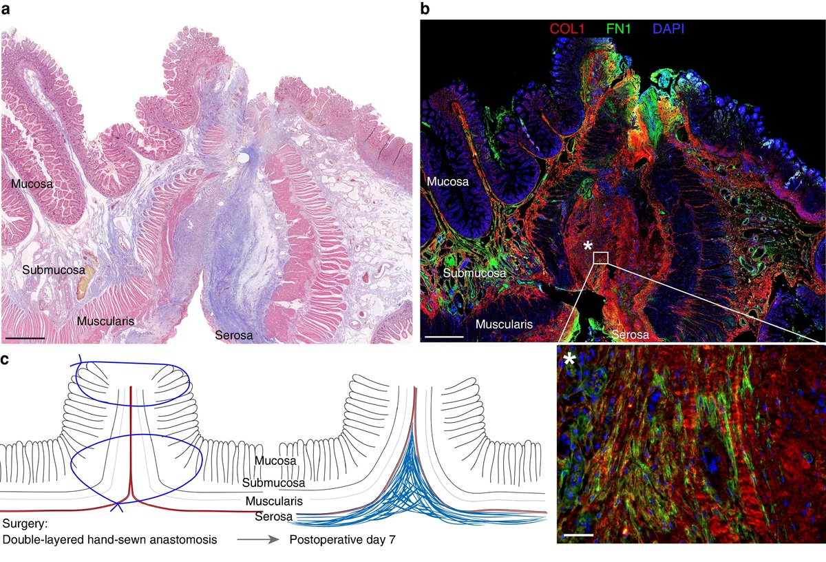 Role of the serosa in intestinal anastomotic healing: insights from in-depth histological analysis of human and murine anastomoses
➡️doi.org/10.1093/bjsope…

In-depth histological analyses of human and murine intestinal anastomoses to investigate the role of the serosal layer of
