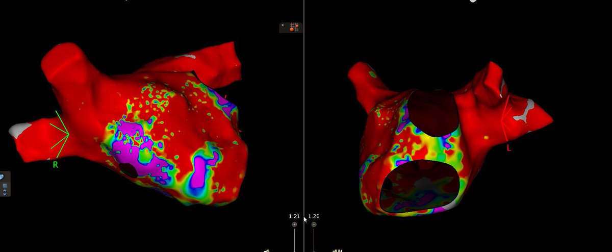 Hakeem Ayinde (@naijaqrs) on Twitter photo 80 F for redo #AF abl. Previous PVI, PWI, CTI durable from previous year.
AF is often driven by progressive atrial myopathy. Lifestyle modification I feel is not discussed enough #AfibAwarenessMonth
<a href="/AZ_EP_DOC/">AFPanico</a> <a href="/AlexTurinMD/">Alex Turin</a> <a href="/peterkistler3/">peterkistler MBBS PhD FHRS</a> <a href="/FaisalMMerchant/">Faisal Merchant</a> <a href="/PrashSanders/">Prash Sanders</a> #EPeeps 80 F for redo #AF abl. Previous PVI, PWI, CTI durable from previous year.
AF is often driven by progressive atrial myopathy. Lifestyle modification I feel is not discussed enough #AfibAwarenessMonth
<a href="/AZ_EP_DOC/">AFPanico</a> <a href="/AlexTurinMD/">Alex Turin</a> <a href="/peterkistler3/">peterkistler MBBS PhD FHRS</a> <a href="/FaisalMMerchant/">Faisal Merchant</a> <a href="/PrashSanders/">Prash Sanders</a> #EPeeps